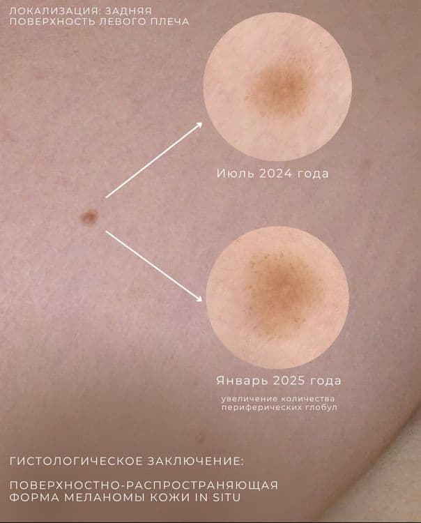 Периферические глобулы и меланома кожи