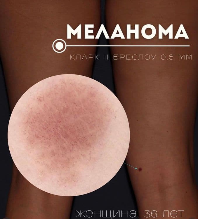 Меланома на фоне частых солнечных ожогов