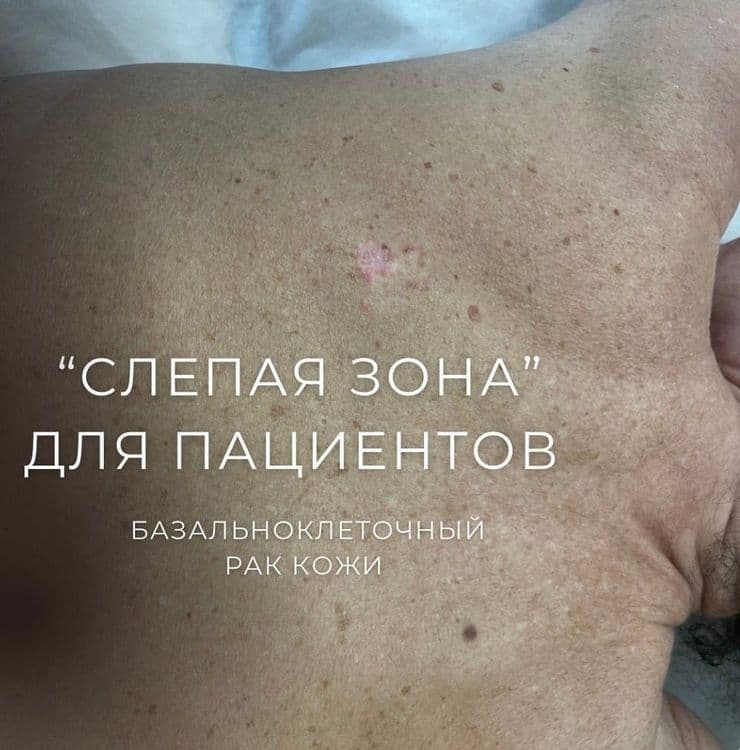 Базальноклеточный рак кожи на спине