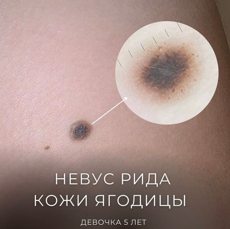 Невус Рида у ребенка