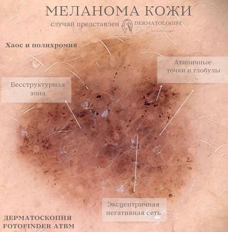 Меланома на лице