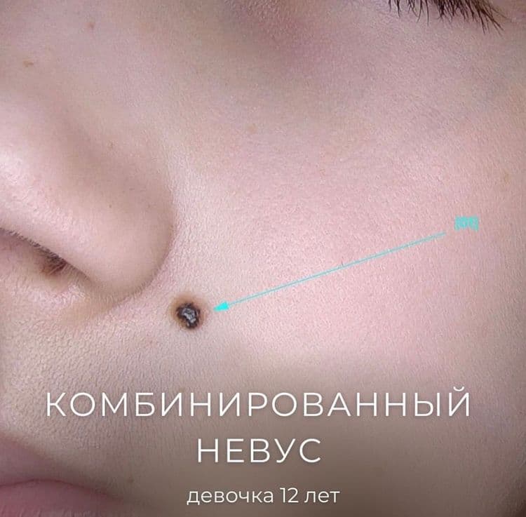 Комбинированный невус на лице у девочки 12 лет