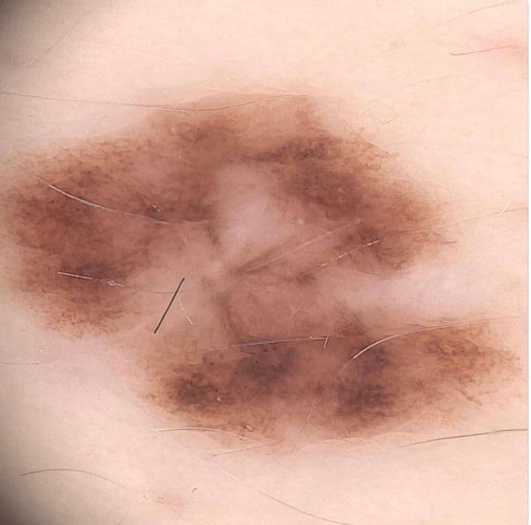 Меланома кожи в 26 лет