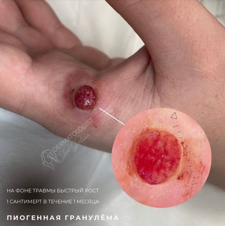 Пиогенная гранулема