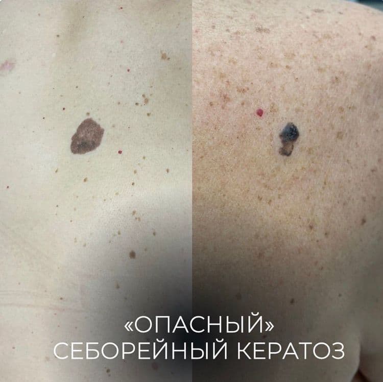«Опасный» себорейный кератоз
