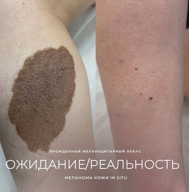 Меланома in situ