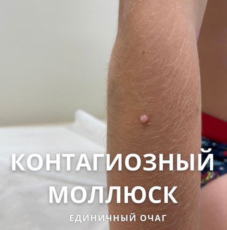 Контагиозный моллюск у детей