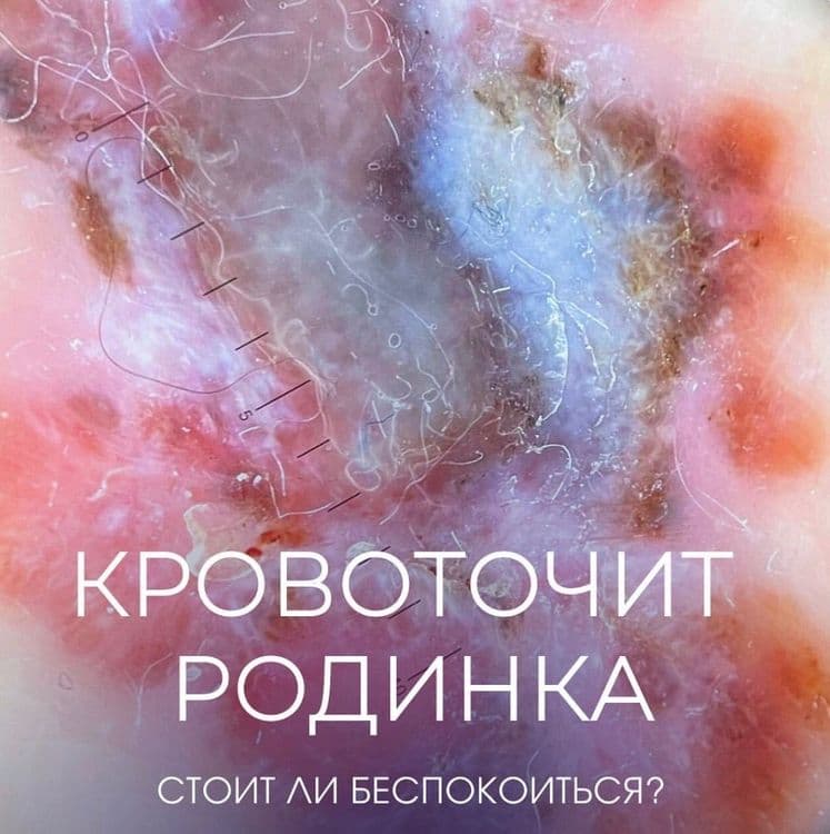 «Кровит родинка» 