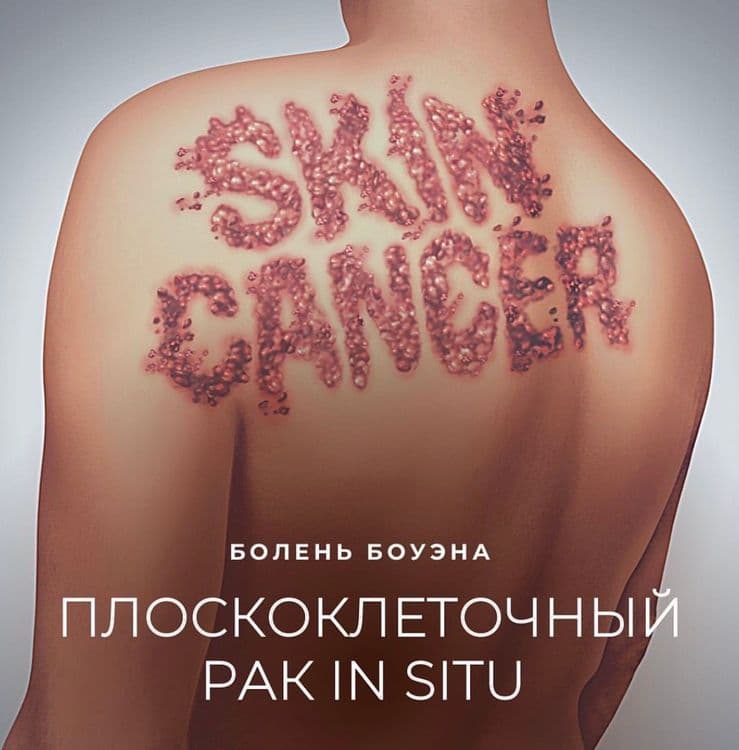 Плоскоклеточный рак кожи