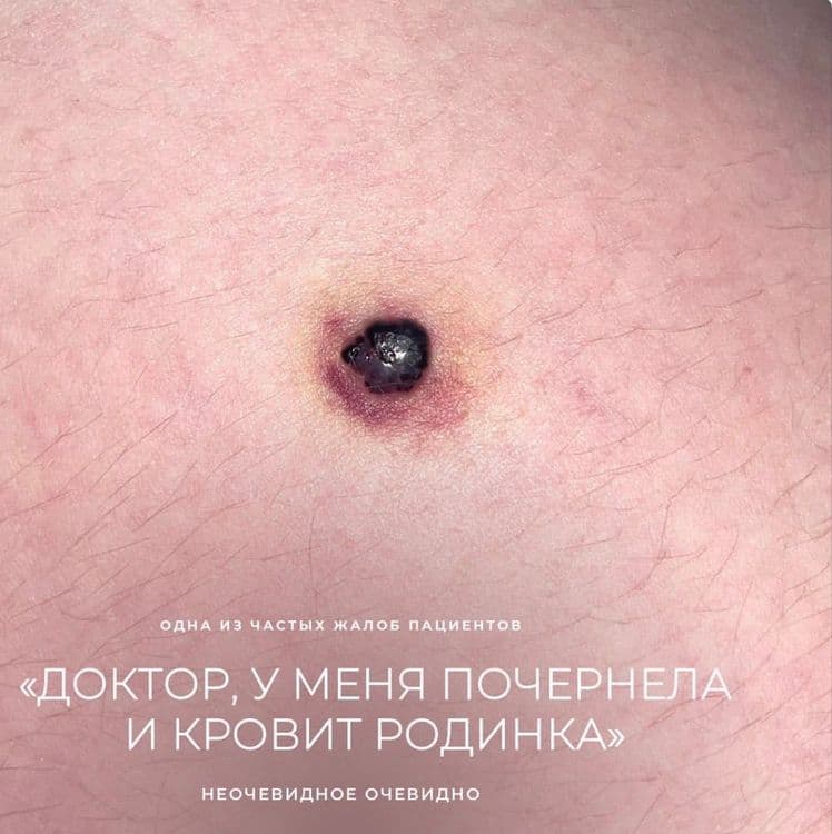 «Почернела родинка»