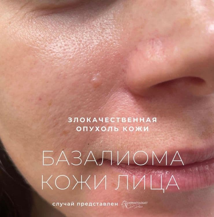 Совсем неприметная базалиома на лице 