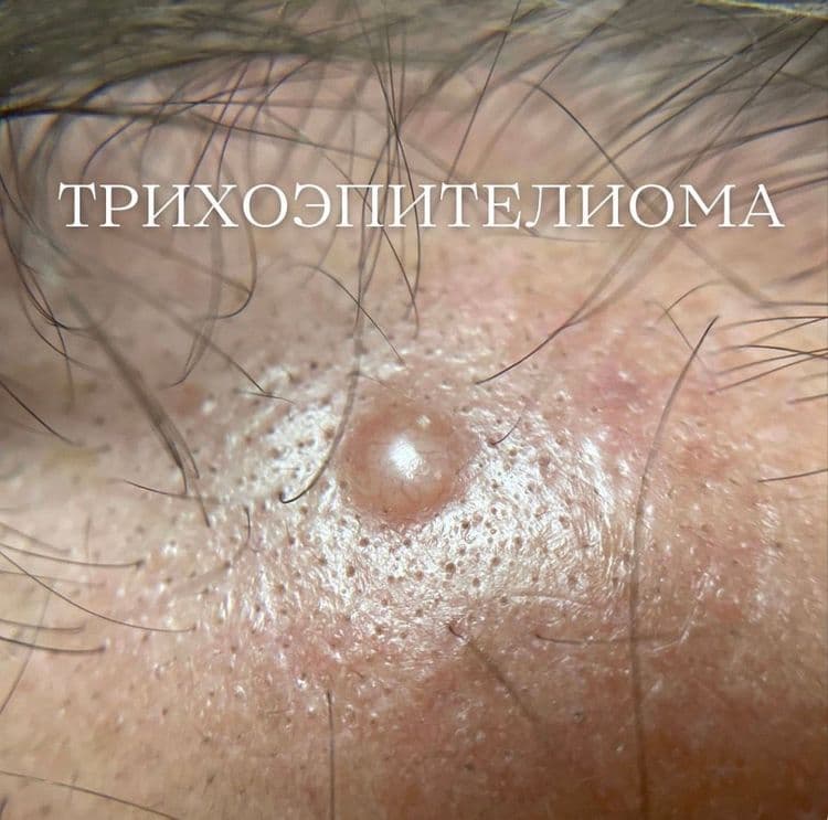 Трихоэпителиома