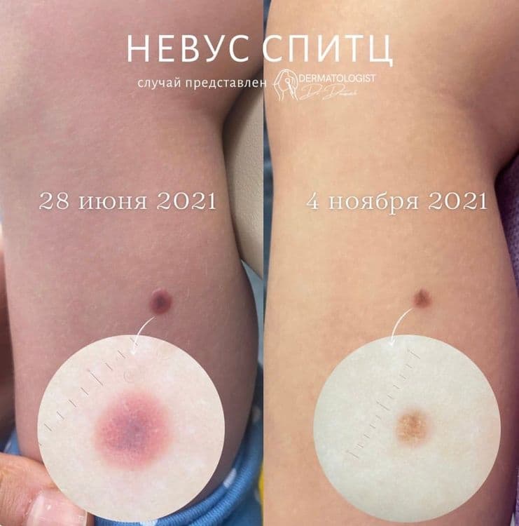 Динамическое наблюдение за невусом Спитц