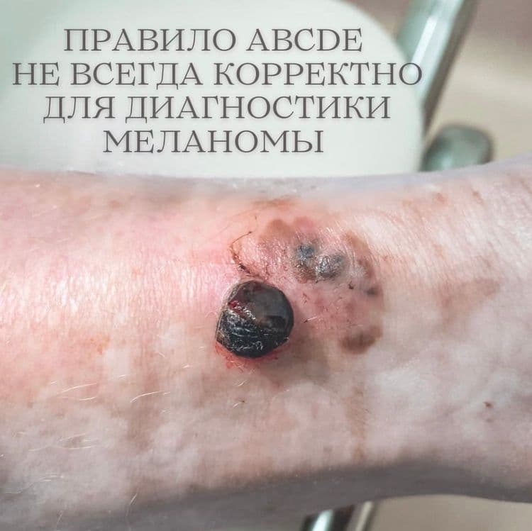 Правило ABCDE работает не всегда 