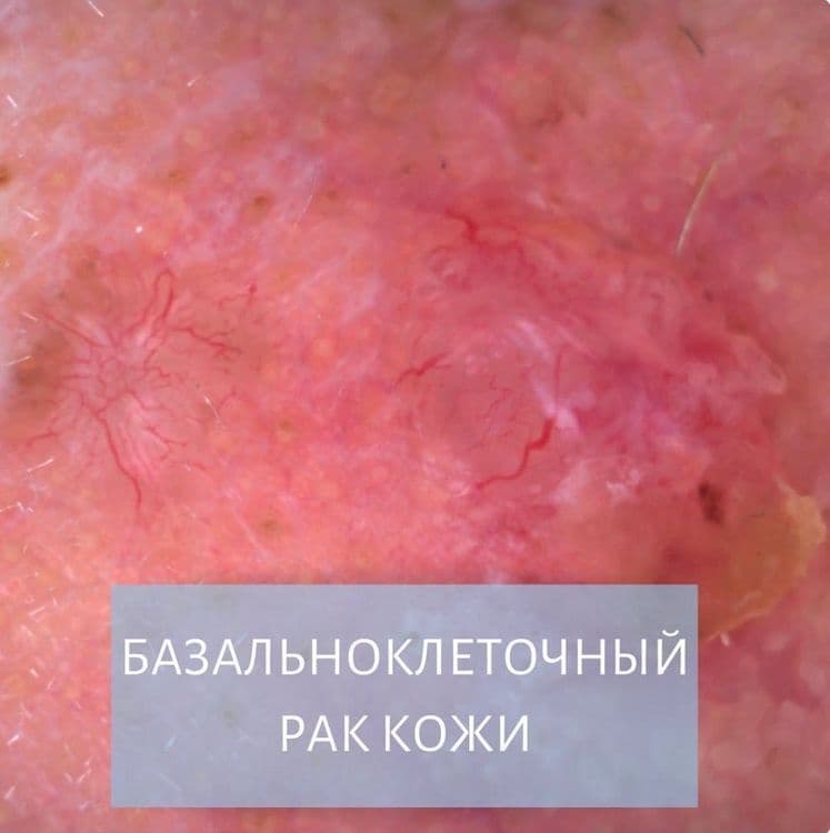 Базальноклеточный рак кожи