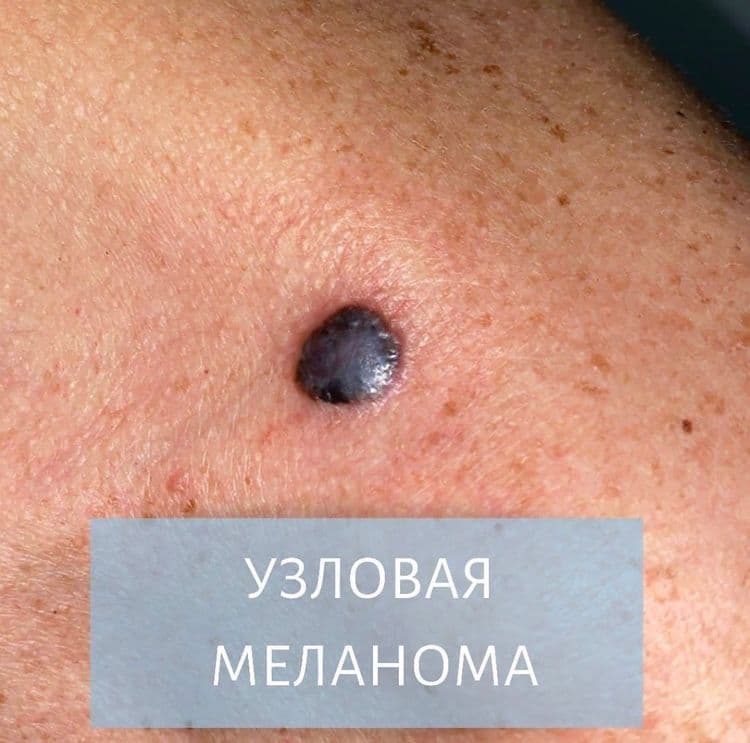 Узловая меланома 