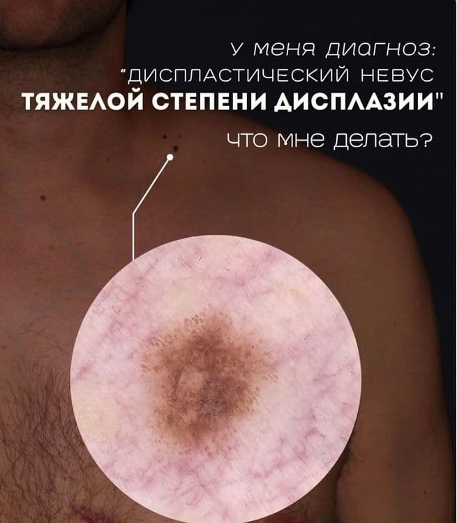 Диспластический невус тяжелой степени дисплазии 