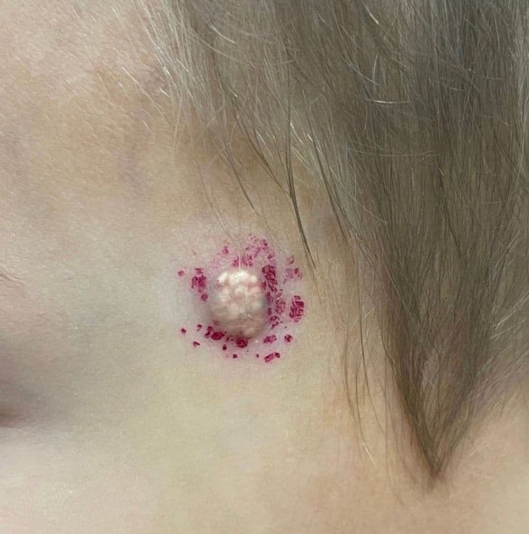 Пиломатрикома - редкая опухоль кожи