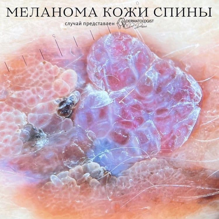 Показания для осмотра «родинок»