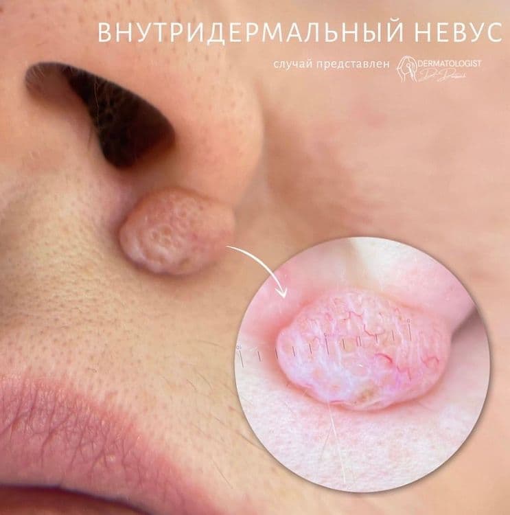 Эстетическое удаления невуса на лице 